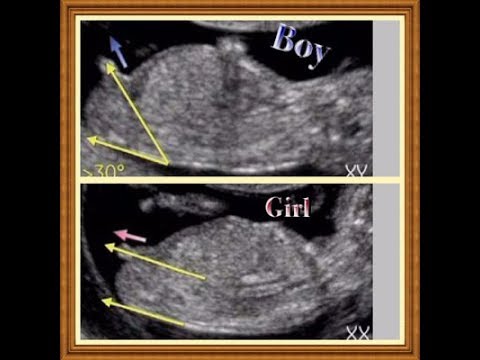 طريقة-مضمونة-100-لمعرفة-نوع-الجنين